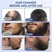 قلم میکرونیدلینگ درماپن برای جوان سازی پوست و رشد مو